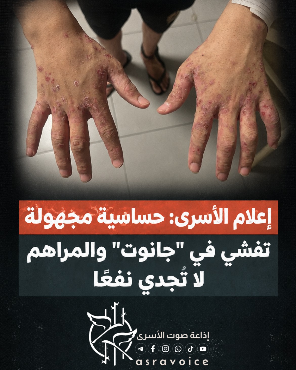 إعلام الأسرى_ حساسية مجهولة تفشي في _جانوت_ والمراهم لا تُجدي نفعاً